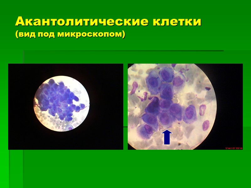 Акантолитические клетки (вид под микроскопом)